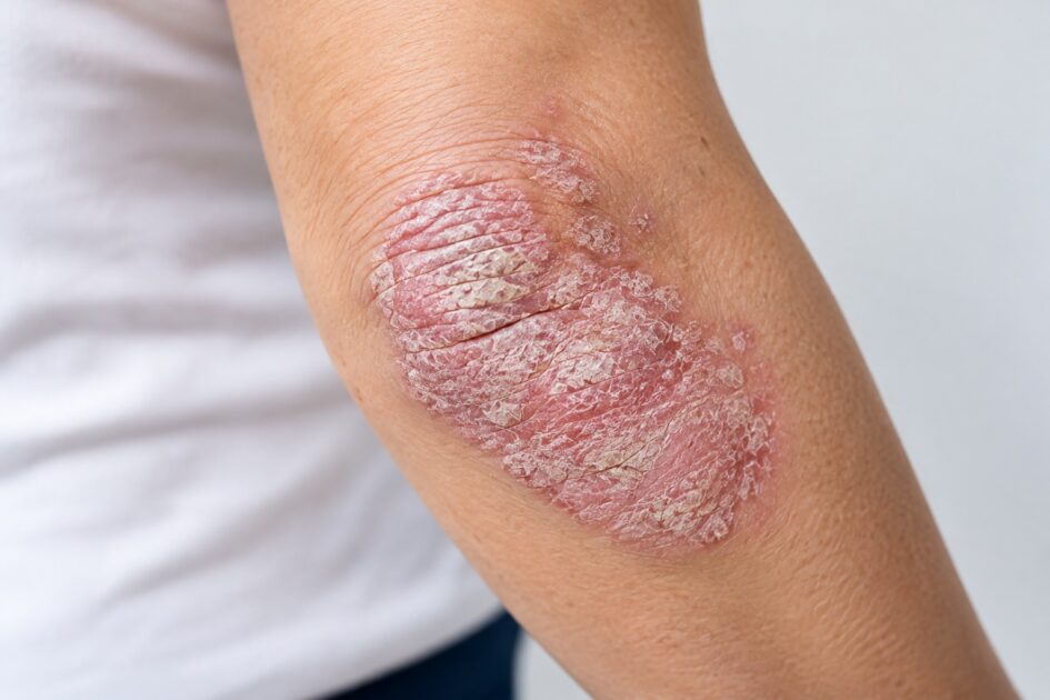 Psoriasis on arm