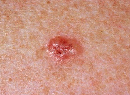 Early Basal Cell Carcinoma Scalp