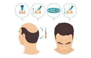 FUE Hair Transplantation Diagram