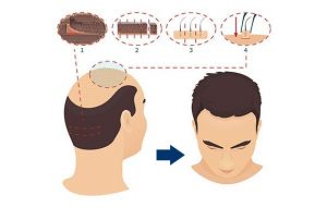 FUT Hair Transplantation Diagram