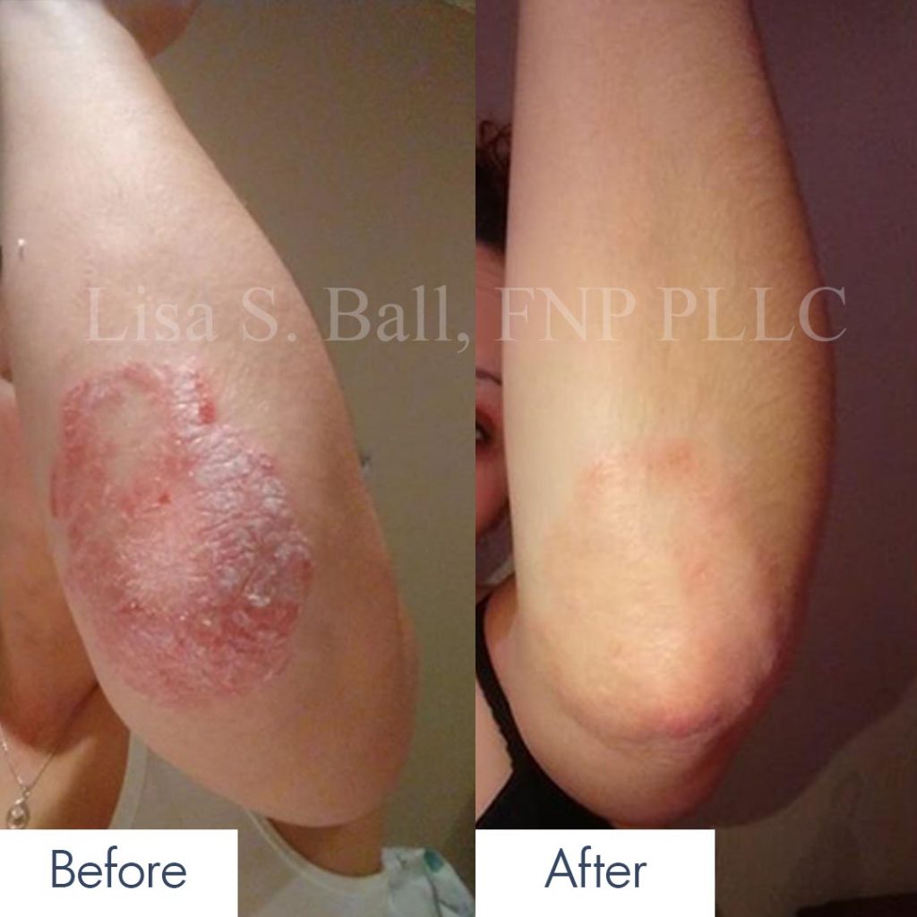 Kim Kardashian Psoriasis Archives Neiman Dermatology   Psoriasis Pt 1024x1024 