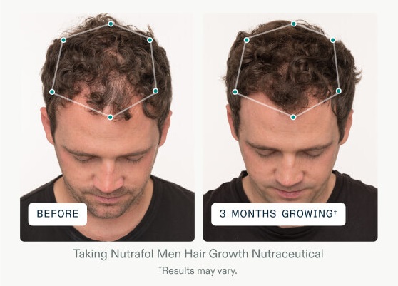 Nutrafol Men Patient Result