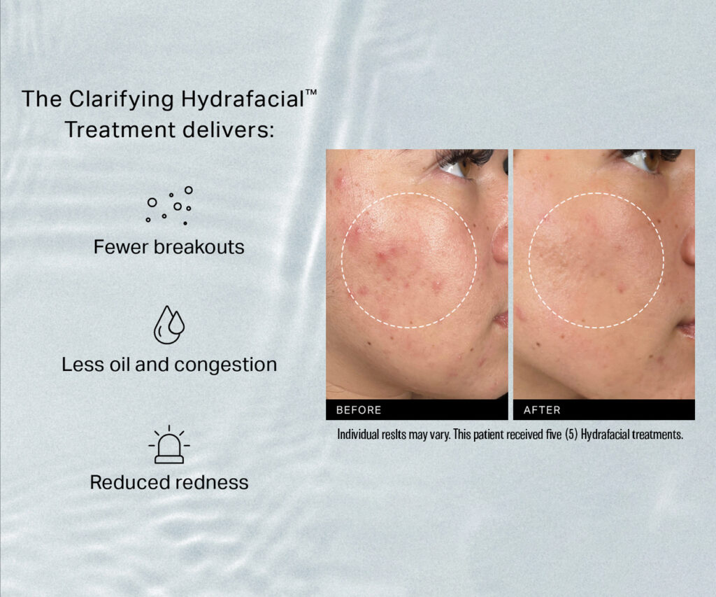 Hydrafacial Acne Information Patient Results