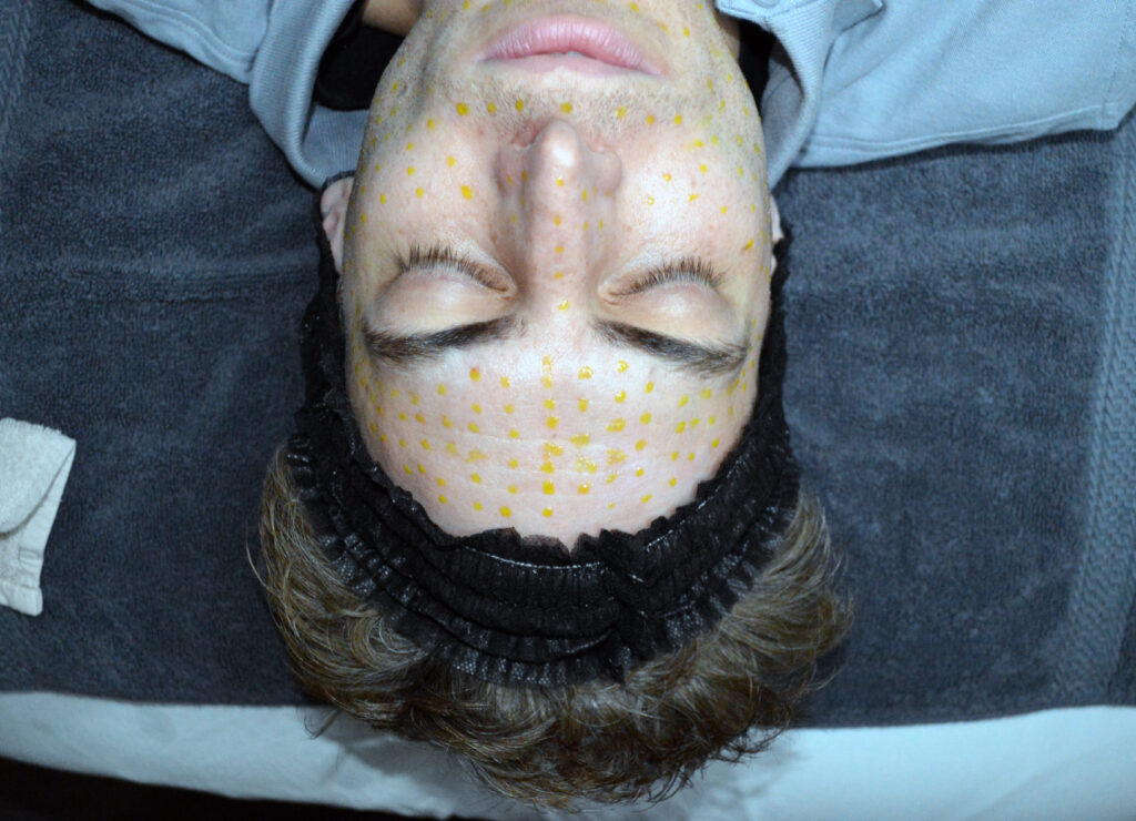 BioRePeel Patient