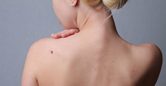 Mole on Back