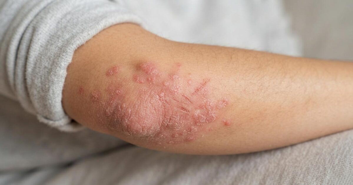 Eczema on arm